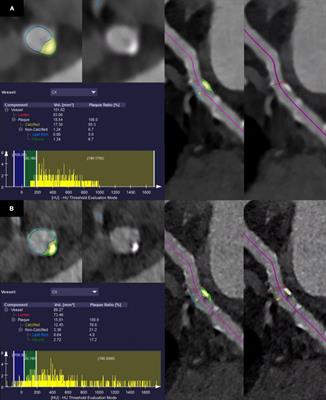 First in-human quantitative plaque characterization with ultra-high resolution coronary photon-counting CT angiography